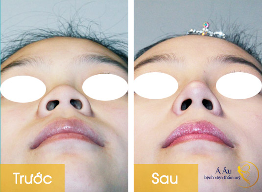 Hình ảnh trước và sau nâng mũi tại Bệnh viện thẩm mỹ Á Âu