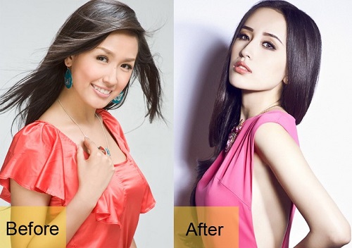 Hình ảnh Hoa Hậu Mai Phương Thúy trước và sau khi nâng mũi tại Bệnh viện Á ÂU.