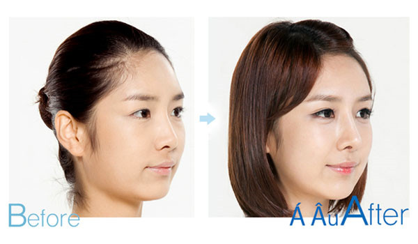 Hình ảnh trước và sau nâng mũi của khách hàng