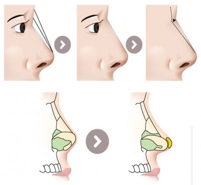 Phần đầu mũi sẽ được bọc sụn tự thân, cho kết quả duy trì dài lâu