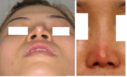 Mũi bị biến chứng dẫn đến tình trạng cong, lệch mũi.