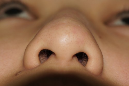 Đầu mũi to khiến cho dáng mũi thiếu sự cân đối, mềm mại 