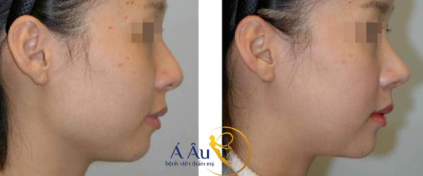 Trước và sau khi nâng mũi tại Bệnh viện thẩm mỹ Á ÂU.