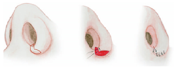 Quy trình phẫu thuật thẩm mỹ thu gọn cánh mũi tại Á Âu.