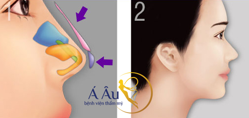 Còn đây là hình ảnh mô phỏng vị trí đặt chất liệu sụn nhân tạo và tự thân của phẫu thuật mũi bọc sụnCòn đây là hình ảnh mô phỏng vị trí đặt chất liệu sụn nhân tạo và tự thân của phẫu thuật mũi bọc sụn