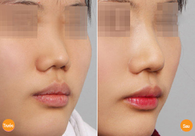 Hình ảnh trước và sau khi nâng mũi tại Á ÂU.