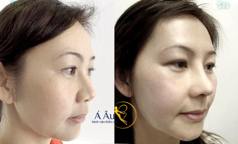 Hình ảnh trước và sau khi nâng mũi tại Bệnh viện thẩm mỹ Á Âu.
