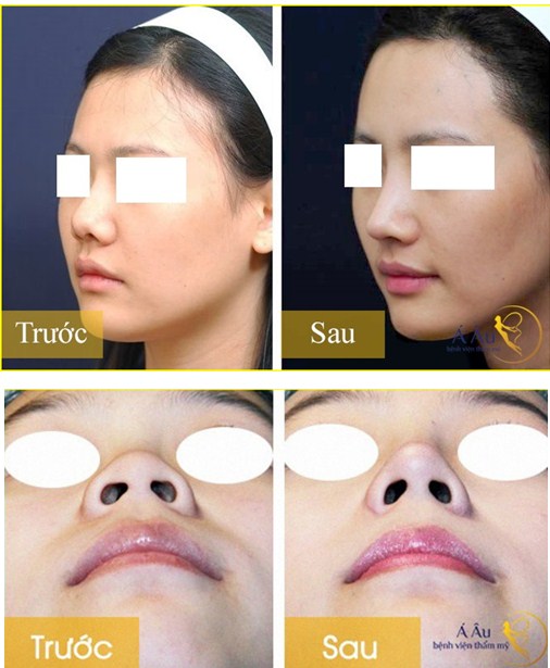 Hình ảnh trước và sau khi tiêm nâng mũi không phẫu thuật.