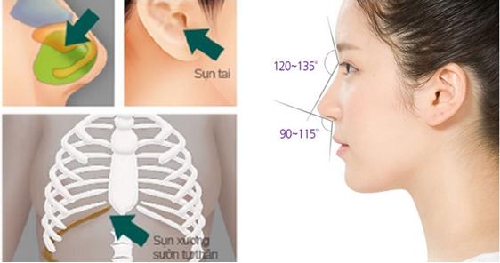 Nâng mũi bọc sụn Hàn quốc sử dụng sụn tự thân trong nâng mũi